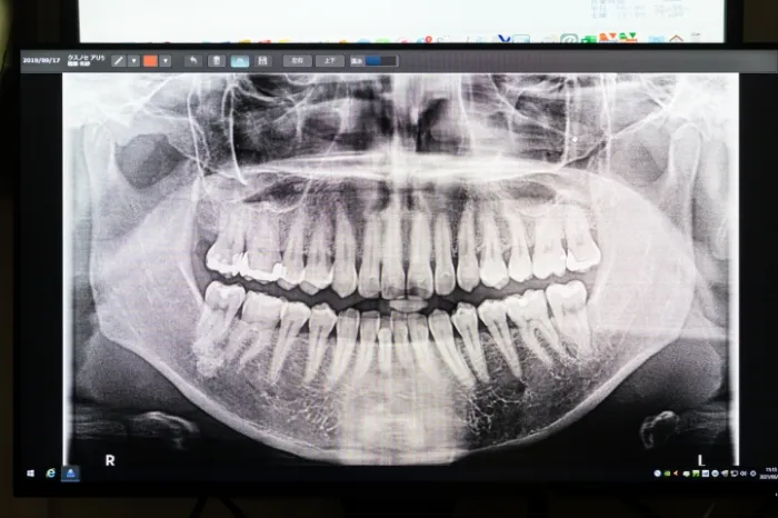 デジタルレントゲン