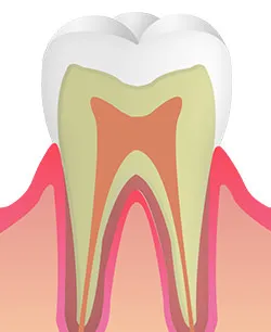 <C0>初期むし歯