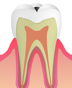 ＜C1＞エナメル質のむし歯
