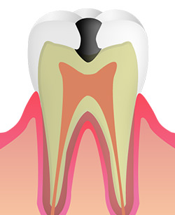 ＜C2＞象牙質のむし歯